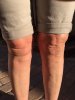 [Bonesmart.org] kmak's TKR recovery thread