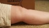 [Bonesmart.org] Lovetocookandsew’s long road to recovery