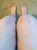 [Bonesmart.org] Lovetocookandsew’s long road to recovery