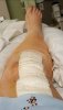 [Bonesmart.org] Lovetocookandsew’s long road to recovery