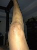 [Bonesmart.org] Having LTKR and praying for a successful outcome…”