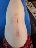 [Bonesmart.org] TKR on right knee at 41