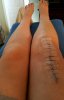 [Bonesmart.org] Lovetocookandsew’s long road to recovery