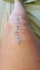 [Bonesmart.org] Lovetocookandsew’s long road to recovery