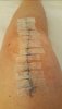 [Bonesmart.org] Lovetocookandsew’s long road to recovery