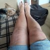 [Bonesmart.org] Pain 2 years after TKR