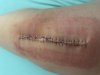 [Bonesmart.org] Eeek’s recovery thread.