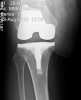 [Bonesmart.org] Flying after surgery