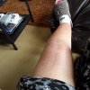 [Bonesmart.org] Pain 2 years after TKR