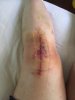 [Bonesmart.org] Joy's Recovery thread<