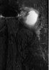 [Bonesmart.org] Constant pain continuing 1 year after THR<^