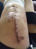 [Bonesmart.org] Marie’s TKR Journey