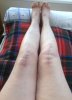 [Bonesmart.org] 79newknees Recovery Thread