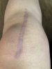 [Bonesmart.org] Desperate for recovery advice<