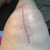 [Bonesmart.org] Indieknee trying to recover