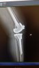 [Bonesmart.org] Partial Revision Failure