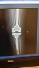 [Bonesmart.org] Partial Revision Failure