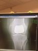 [Bonesmart.org] My Drama Queen Patellofemoral Knee