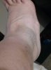 [Bonesmart.org] Mom2Lucy's Recovery Thread