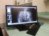 [Bonesmart.org] Hip surgery in my future