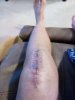 [Bonesmart.org] Beachy in recovery<