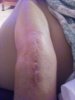 [Bonesmart.org] Beachy in recovery<