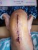 [Bonesmart.org] Beachy in recovery<