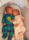 [Bonesmart.org] Post-THR Twins Born!