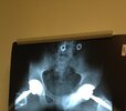 [Bonesmart.org] Post-op. Now at home.