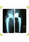 [Bonesmart.org] Post-op. Now at home.