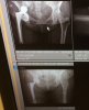 [Bonesmart.org] Bilateral changed to Single