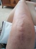 [Bonesmart.org] Beachy in recovery<