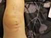 [Bonesmart.org] New Knee #2 Recovery<
