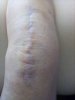 [Bonesmart.org] Beachy in recovery<
