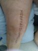 [Bonesmart.org] Grandma Chris gets a new knee!