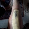 [Bonesmart.org] Pain 2 years after TKR