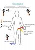 [Bonesmart.org] Femoral Nerve Damage?<