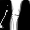 [Bonesmart.org] Instability Question
