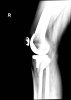 [Bonesmart.org] Instability Question