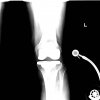 [Bonesmart.org] Instability Question