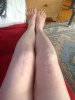 [Bonesmart.org] 79newknees Recovery Thread