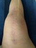 [Bonesmart.org] Grandma Chris gets a new knee!