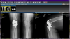 [Bonesmart.org] No Kneecap and a TKR Experience