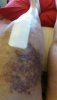[Bonesmart.org] Bionic's final op - fingers crossed<