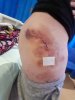 [Bonesmart.org] Rhiannon89's recovery thread