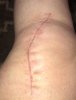 [Bonesmart.org] x2  Knitmama's Recovery Journey