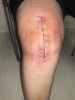 [Bonesmart.org] Irish471's Recovery Thread