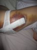 [Bonesmart.org] Fairydell's recovery thread