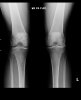 [Bonesmart.org] PKR Success - 1 yr out.