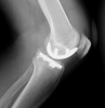 [Bonesmart.org] PKR Success - 1 yr out.